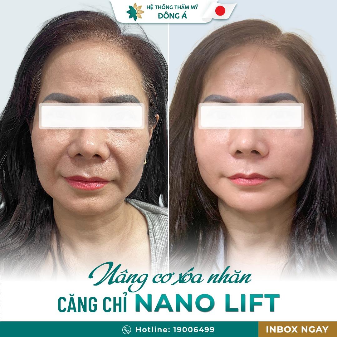 Khám phá 7 Thẩm mỹ viện hàng đầu Hà Nội chuyên căng da mặt bằng chỉ