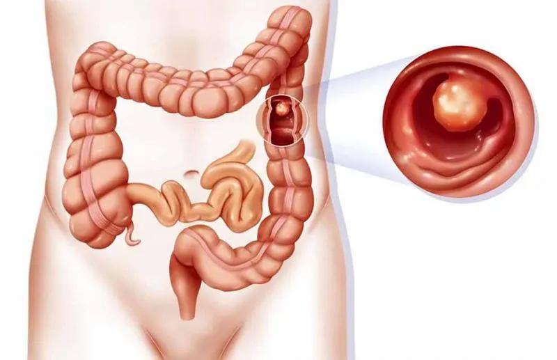 10 Lưu ý Quan Trọng Về Bệnh Crohn