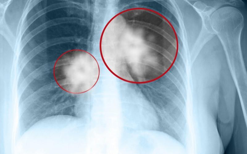 8 Điểm Cốt Yếu Cần Nhớ Khi Chụp PET/CT
