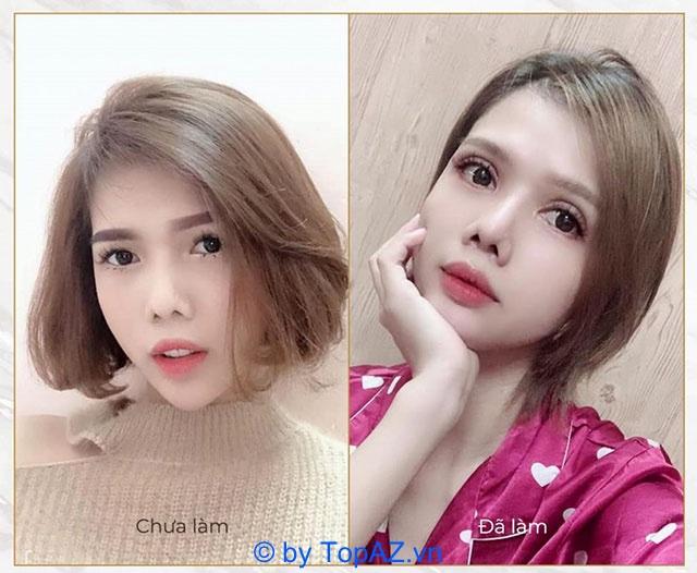 Top 5 địa chỉ phẫu thuật mở rộng góc mắt uy tín và an toàn tại TP.HCM