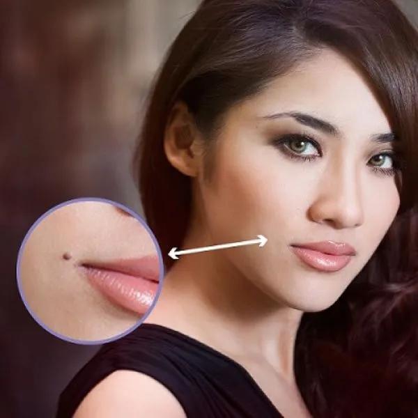 7 Địa Chỉ Tẩy Nốt Ruồi Uy Tín & Hiệu Quả Nhất Tại Hà Nội