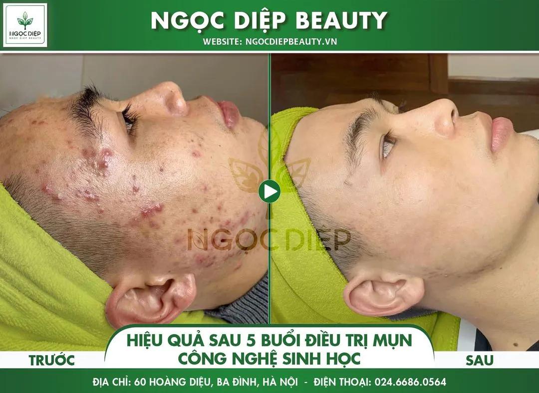 Top 10 địa chỉ Spa trị mụn chất lượng hàng đầu tại quận Ba Đình, Hà Nội