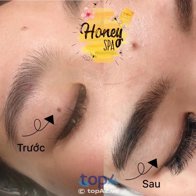 5 Địa chỉ đốt mụn thịt uy tín nhất Quận 6 – Hiệu quả và an toàn vượt trội