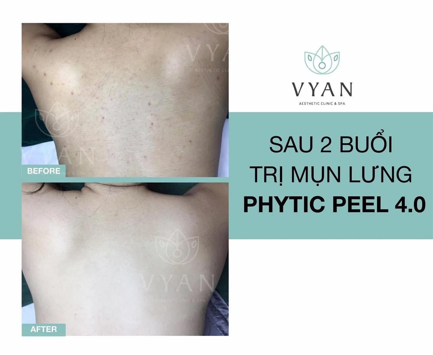 Top 10 địa chỉ trị mụn lưng chất lượng và hiệu quả bậc nhất Hà Nội