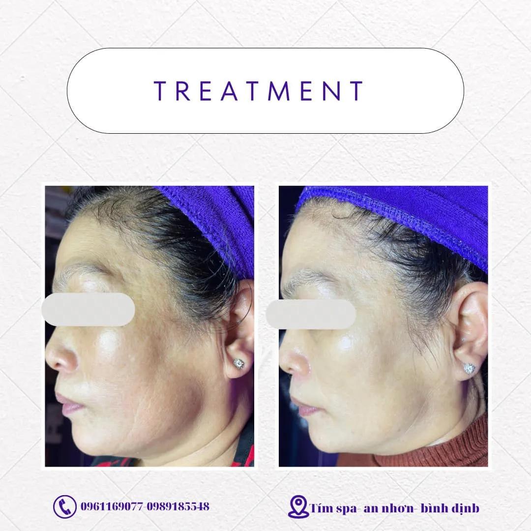5 Spa Nổi Tiếng Nhất An Nhơn, Bình Định Dành Cho Sắc Đẹp
