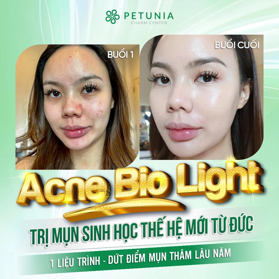 Top 11 địa chỉ trị mụn uy tín và hiệu quả nhất tại Hà Nội