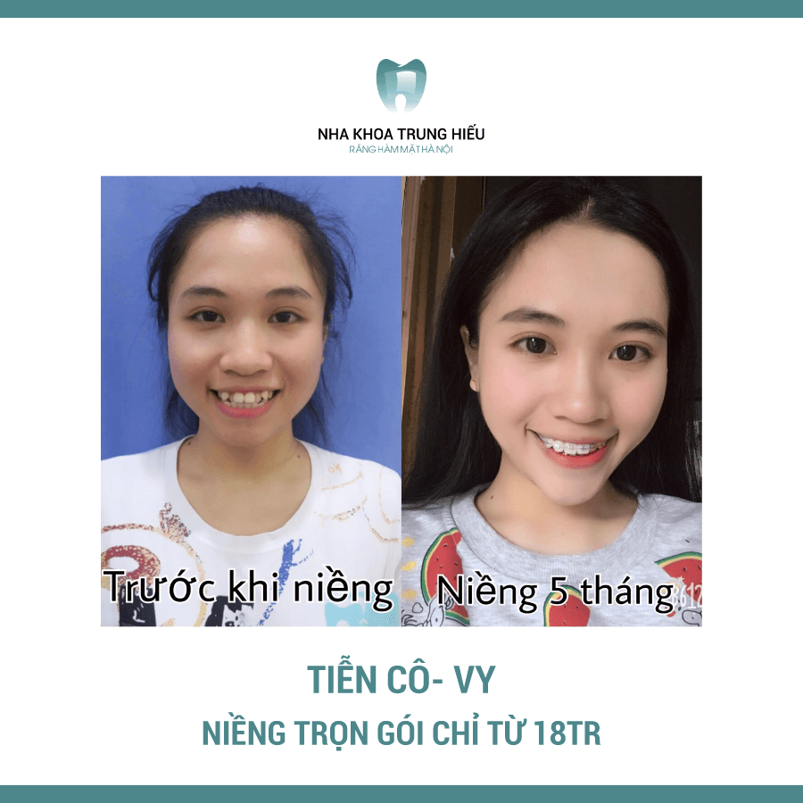 Top 4 địa chỉ niềng răng chất lượng, uy tín hàng đầu tại quận Hoàng Mai, Hà Nội