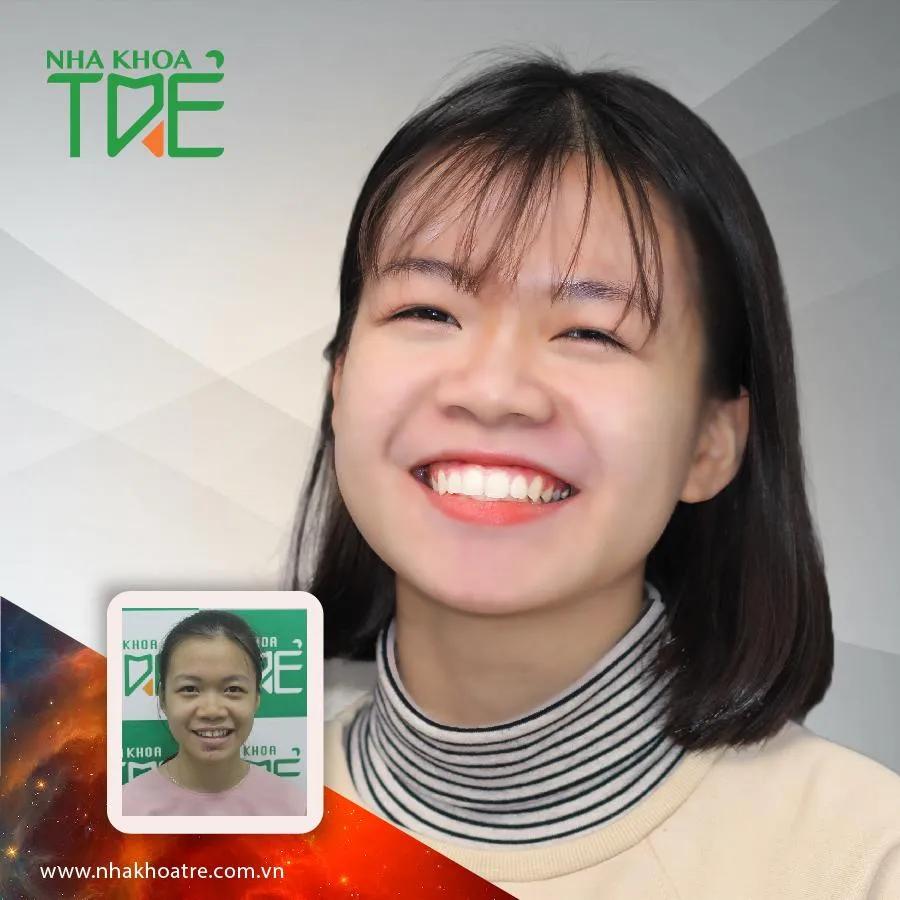 6 Địa chỉ niềng răng chất lượng và đáng tin cậy hàng đầu tại quận Thanh Xuân, Hà Nội