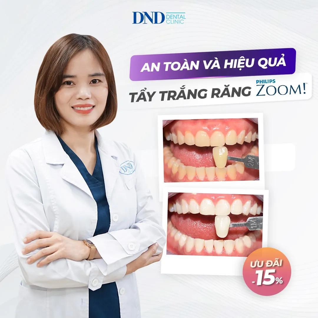 Top 7 Địa Chỉ Tẩy Trắng Răng Uy Tín Nhất Tại Quận Hai Bà Trưng, Hà Nội