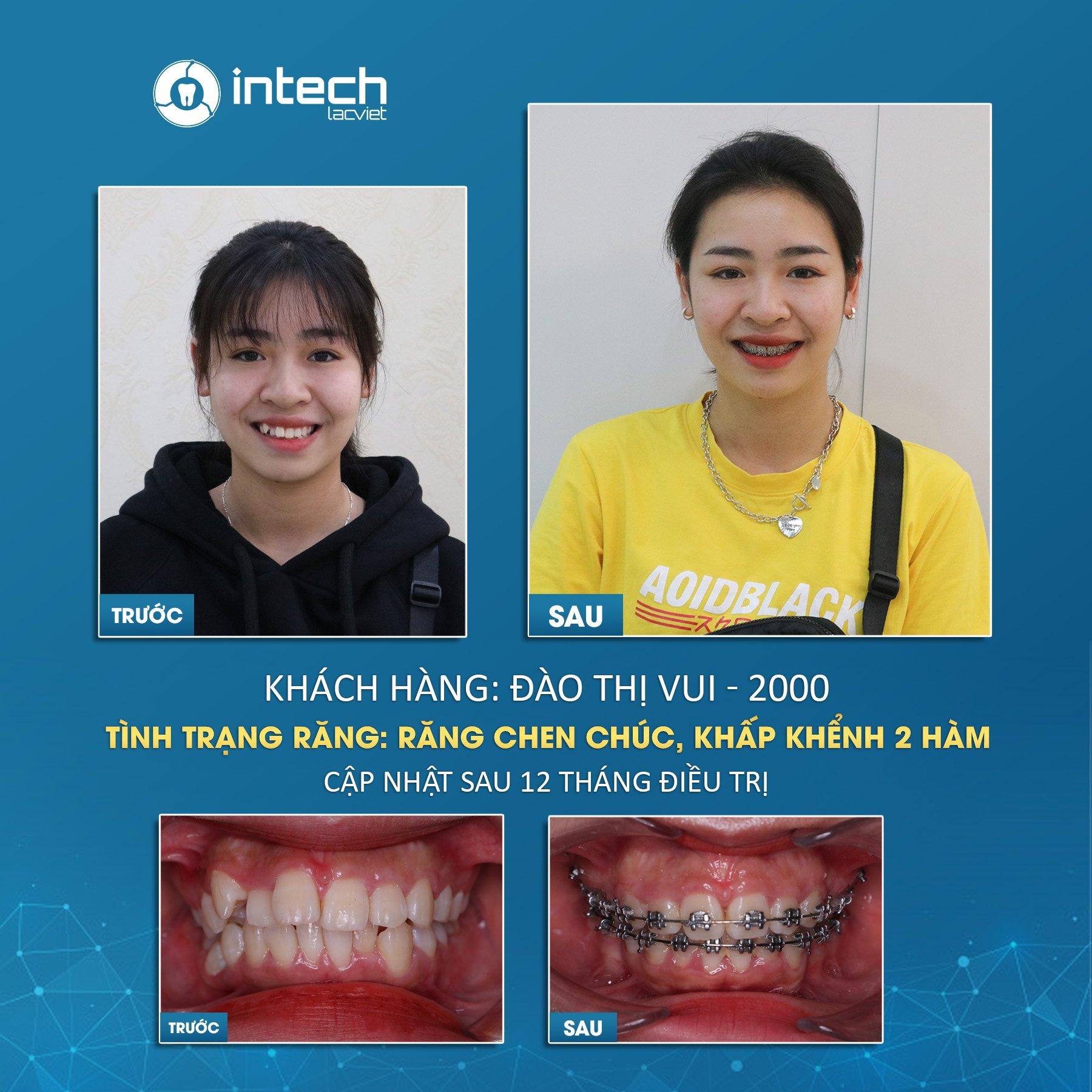 Top 8 địa chỉ niềng răng chất lượng và đáng tin cậy nhất tại quận Cầu Giấy, Hà Nội