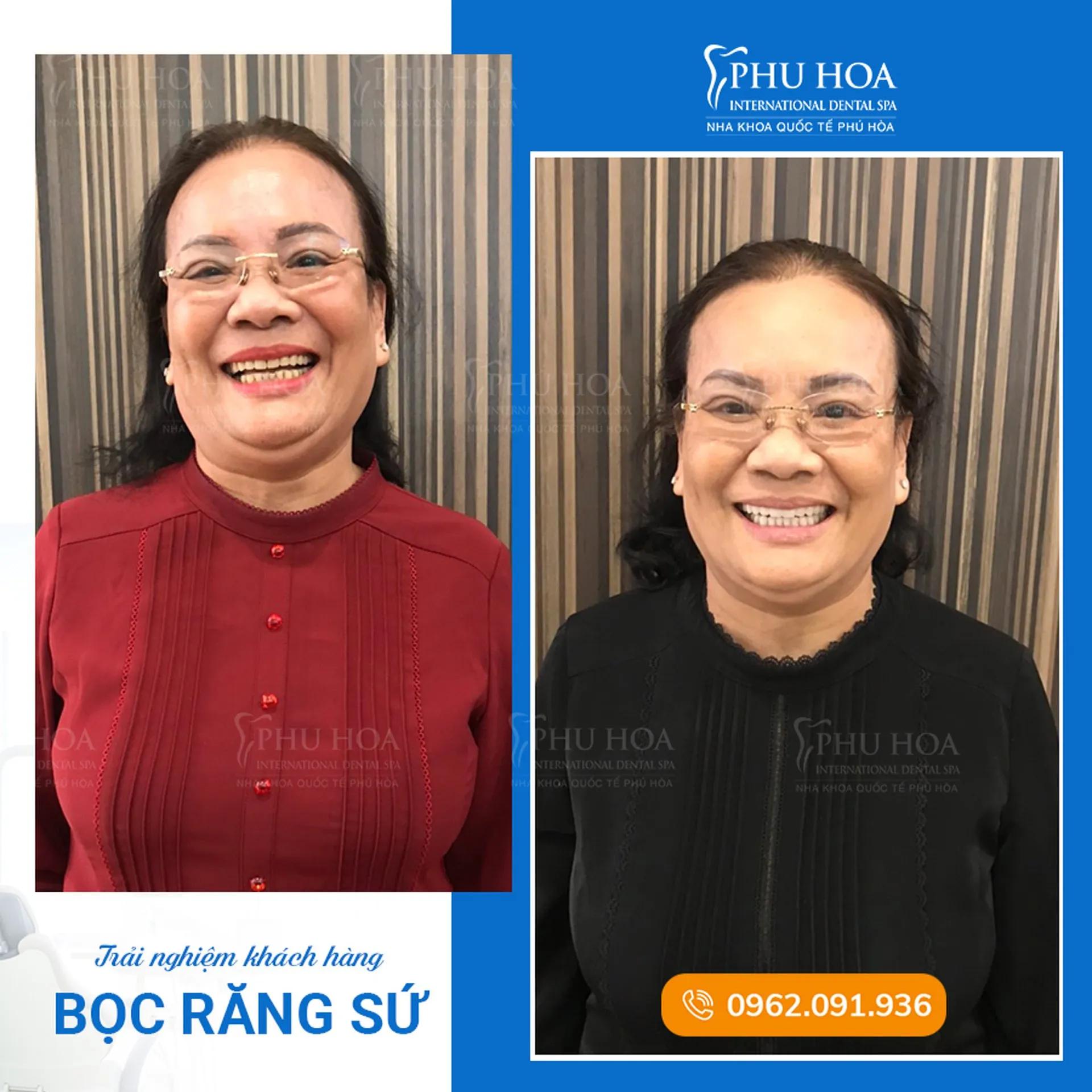 Top 6 địa chỉ bọc răng sứ đẹp và chất lượng nhất tại quận Hai Bà Trưng, Hà Nội