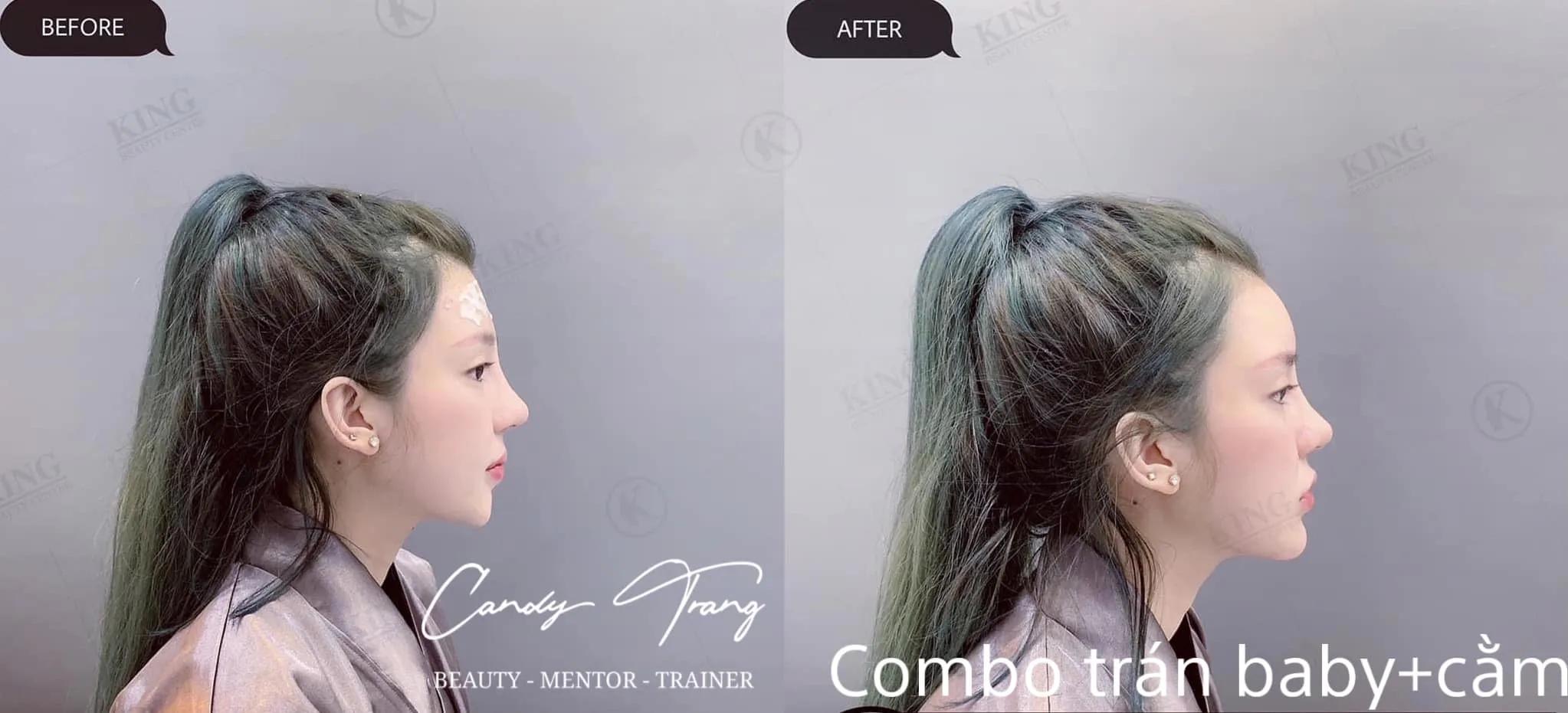 Top 8 địa chỉ tiêm filler - botox uy tín và chất lượng hàng đầu tại Hải Phòng