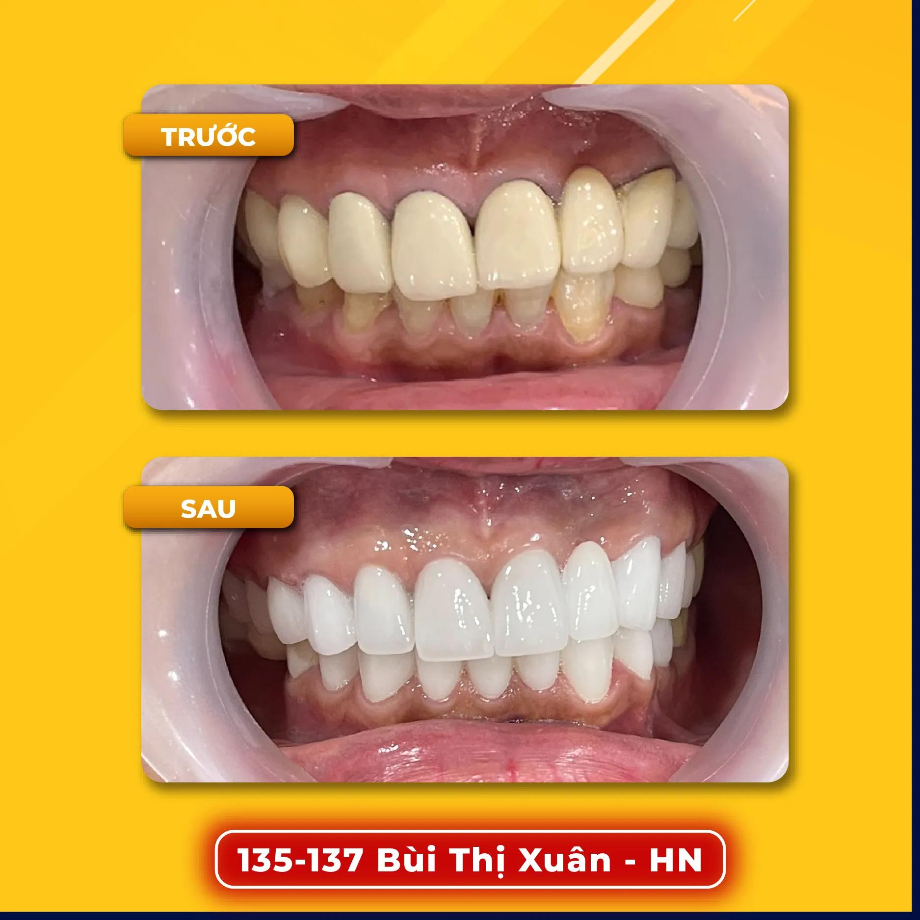 10 địa chỉ hàng đầu điều trị viêm nha chu đáng tin cậy nhất tại Hà Nội
