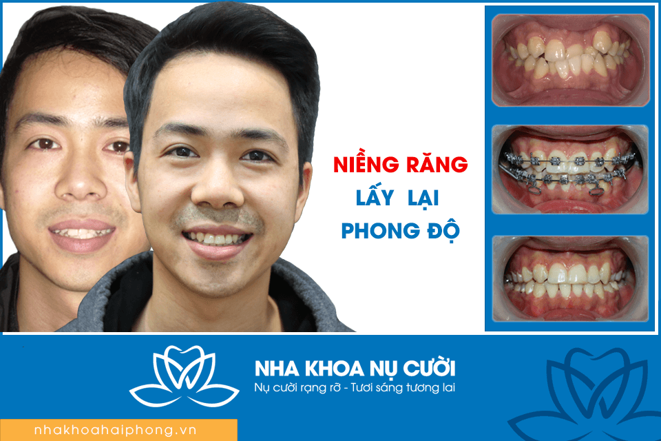 9 Địa Chỉ Niềng Răng Đáng Tin Cậy Nhất Tại Thành Phố Cảng