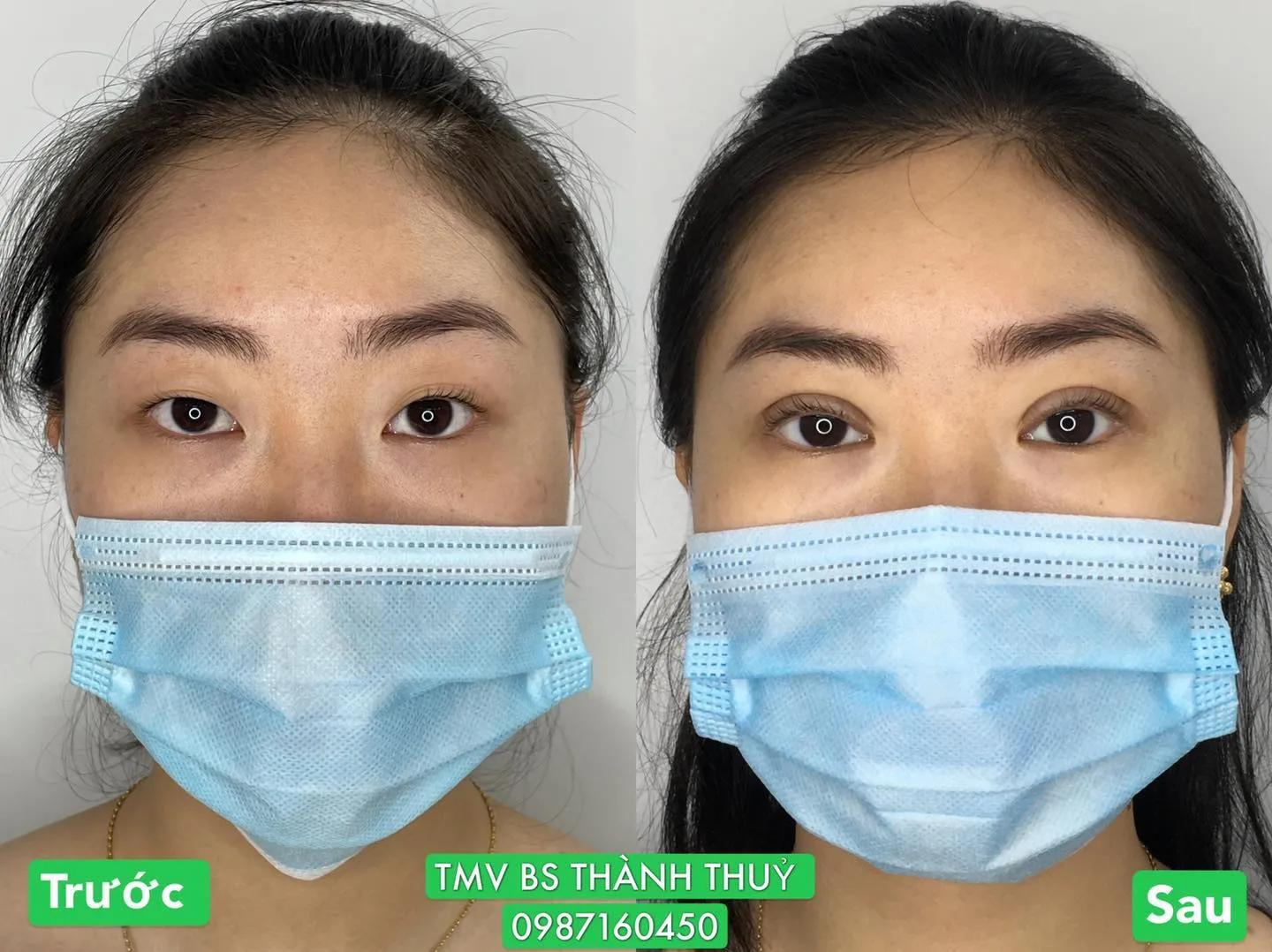 Top 9 địa chỉ nhấn mí, cắt mí đẹp và uy tín bậc nhất tại Hải Phòng