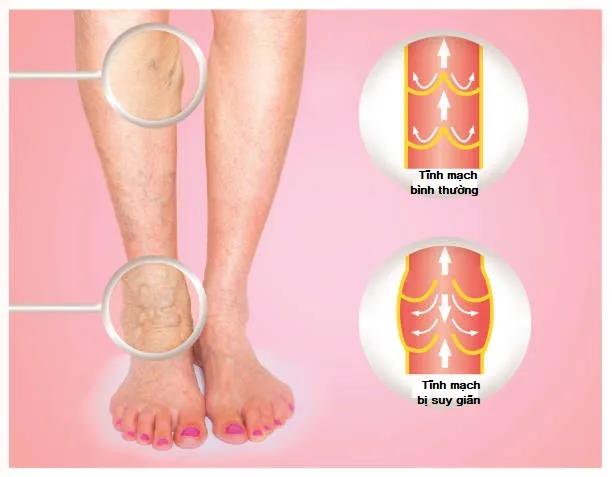 Top 6 Địa chỉ khám và điều trị suy giãn tĩnh mạch uy tín nhất tại Hà Nội
