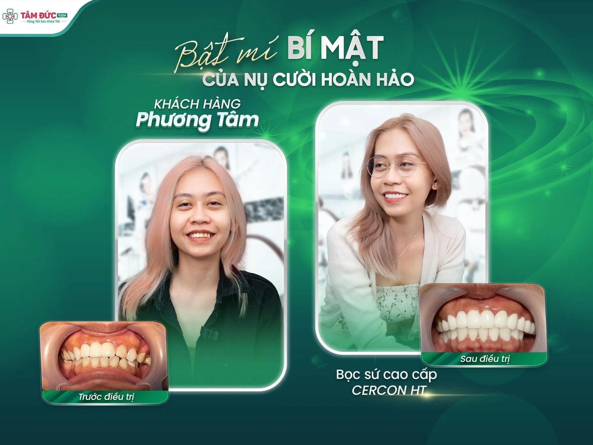 Top 10 Địa chỉ bọc răng sứ uy tín và đẹp nhất tại TP. Quy Nhơn, Bình Định