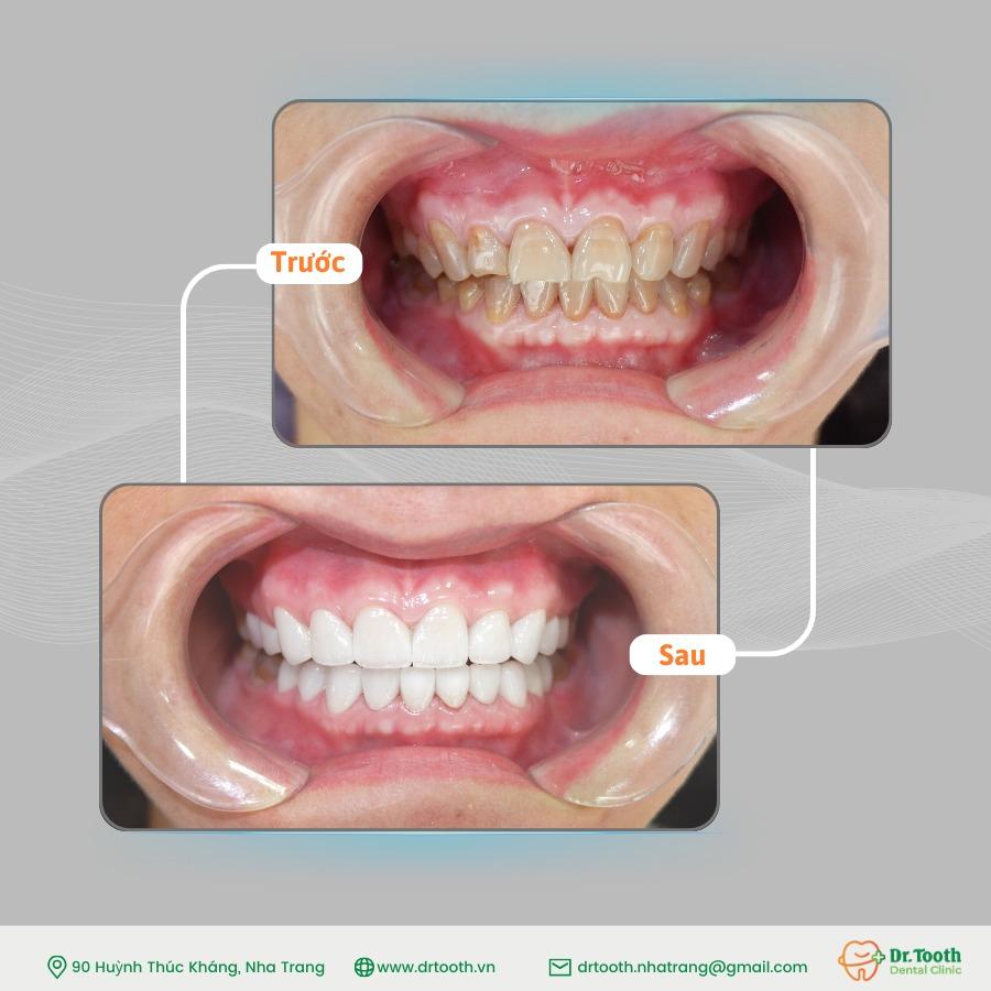 Top 12 địa chỉ bọc răng sứ chất lượng và uy tín hàng đầu tại Nha Trang