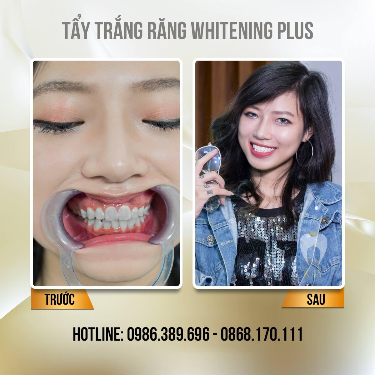 6 địa chỉ tẩy trắng răng đáng tin cậy nhất tại quận Đống Đa, Hà Nội