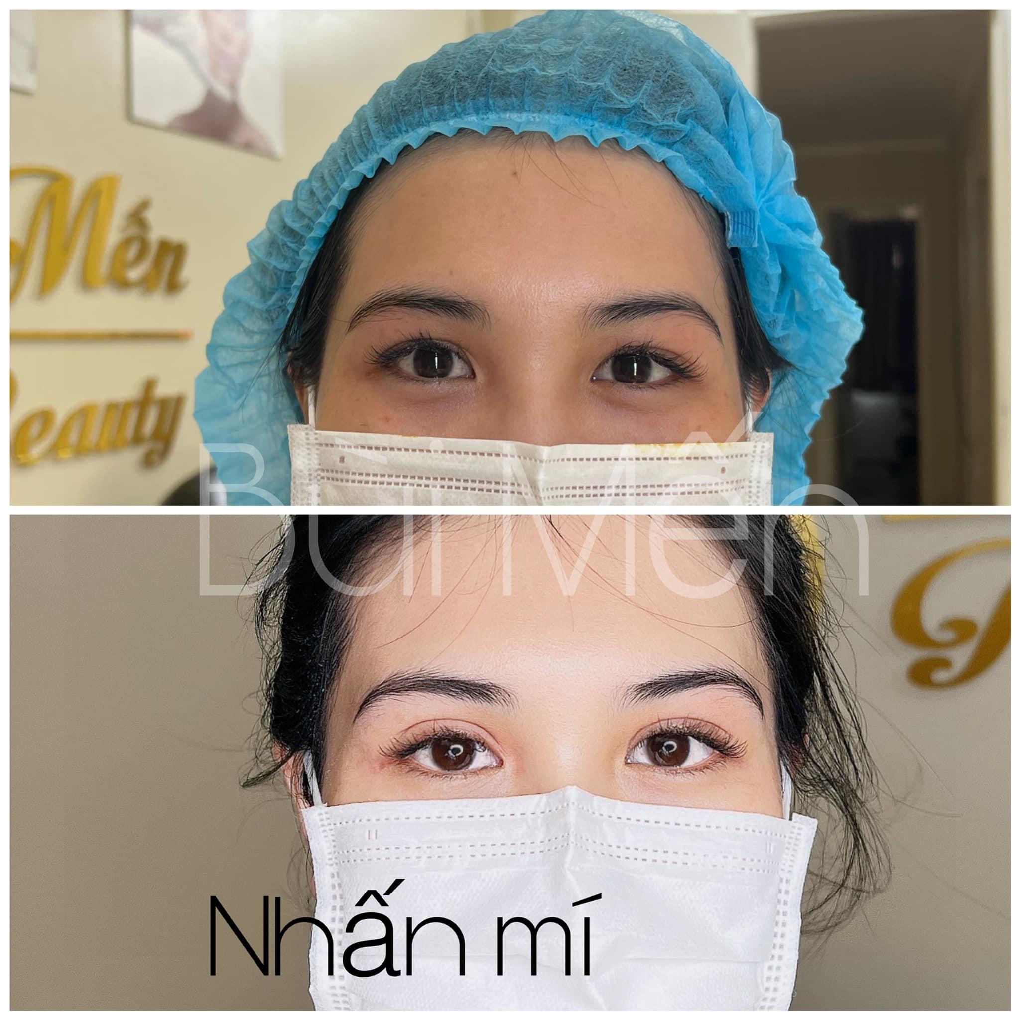 Top 5 địa chỉ cắt mí, nhấn mí đẹp và an toàn nhất tại Nha Trang