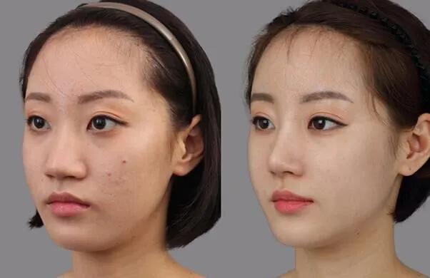 10 địa chỉ cắt, thu gọn cánh mũi uy tín và an toàn nhất tại TP.HCM