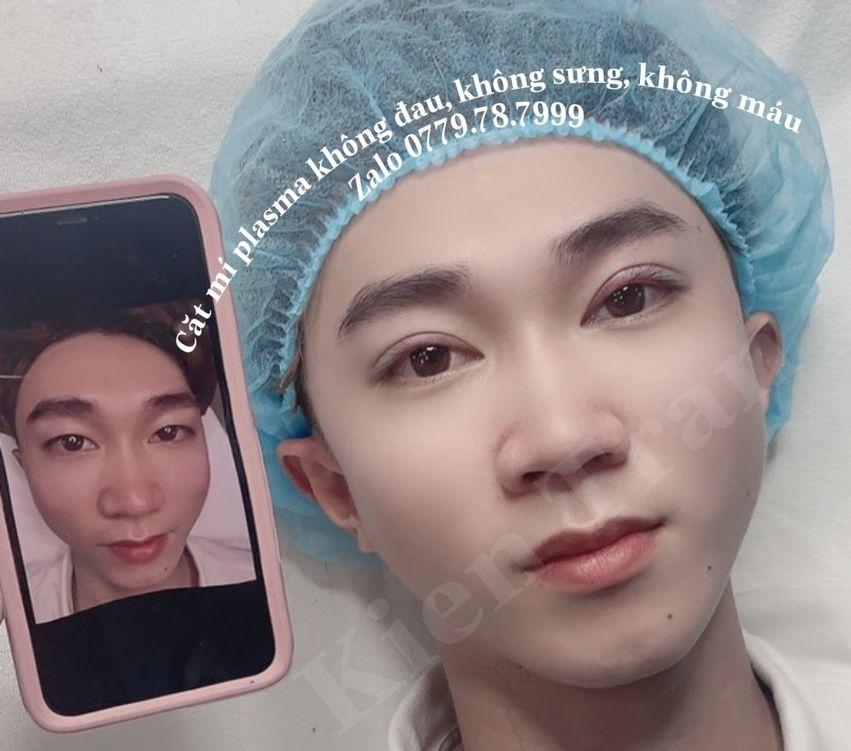 Top 10 địa chỉ nhấn mí, cắt mí đẹp và đáng tin cậy tại TP. Thủ Dầu Một, Bình Dương