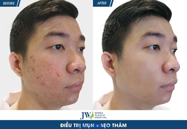 Khám phá 11 spa trị mụn cho nam giới tại TPHCM với chất lượng được đánh giá cao