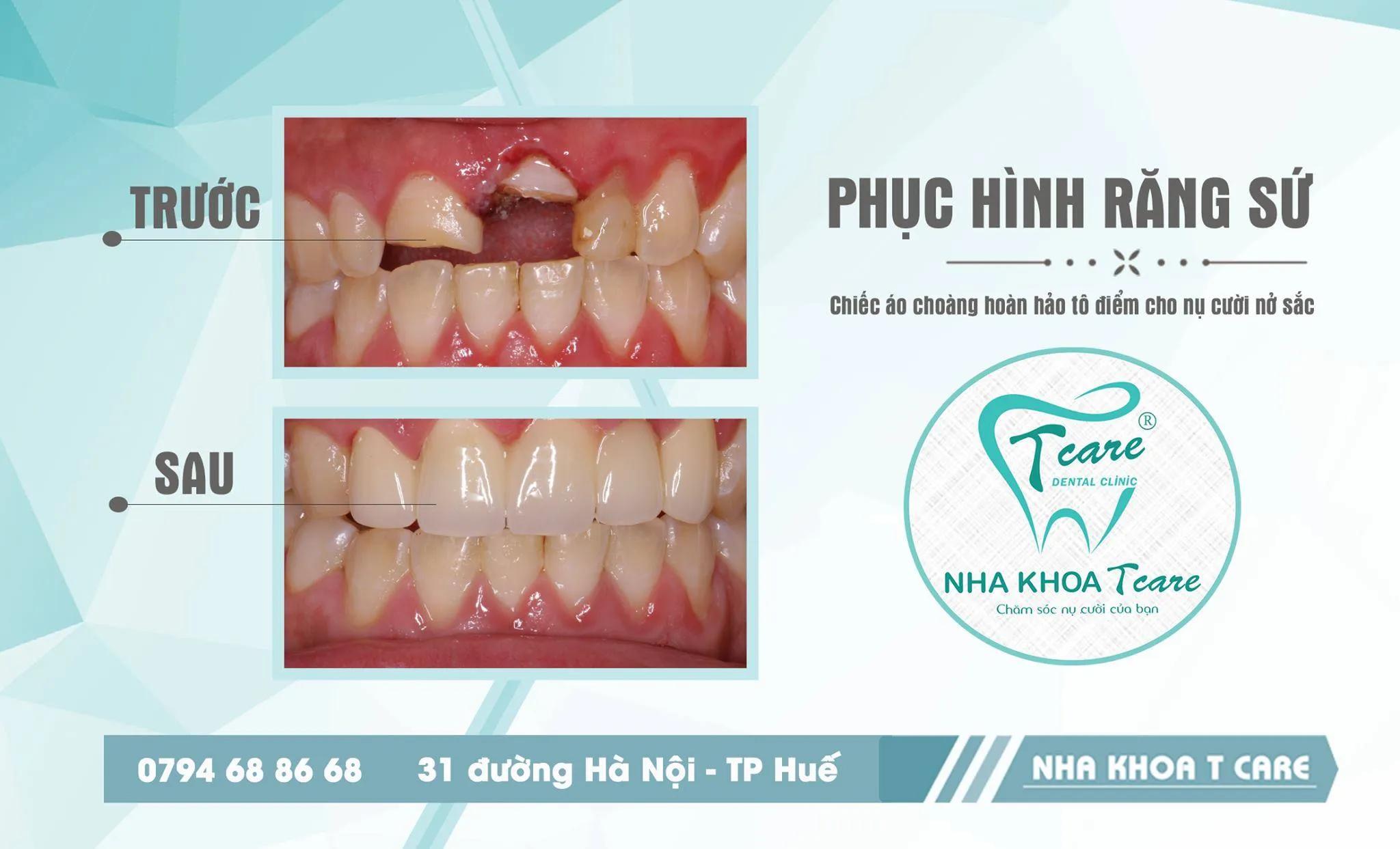 7 Địa chỉ bọc răng sứ uy tín và chất lượng hàng đầu tại Huế