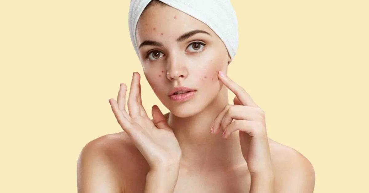 Top 5 địa chỉ điều trị mụn hiệu quả tại quận Bình Thạnh, TP. HCM