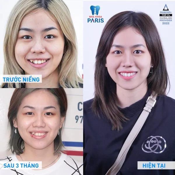 9 Địa Chỉ Niềng Răng Chất Lượng Nhất Thủ Dầu Một, Bình Dương