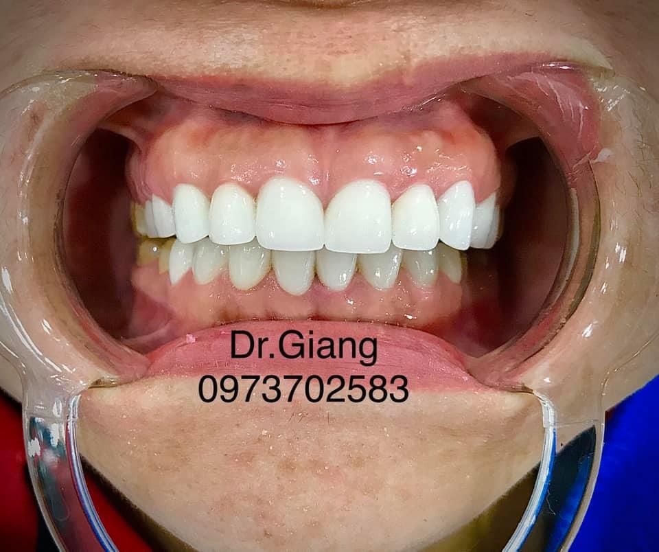 Top 6 địa chỉ bọc răng sứ chất lượng, uy tín bậc nhất tại quận Ba Đình, Hà Nội