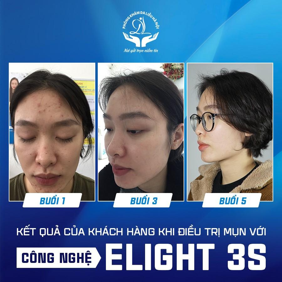 Top 8 Phòng Khám Da Liễu Chuyên Trị Mụn Tốt Nhất Tại Hà Nội