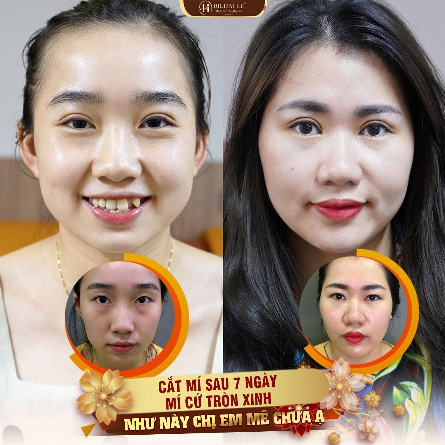 Top 10 địa chỉ nhấn mí, cắt mí đẹp tự nhiên và an toàn bậc nhất tại TP. HCM