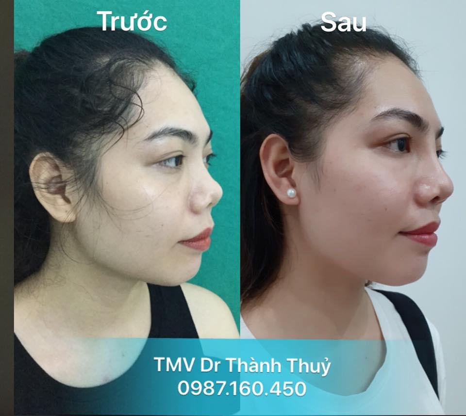 Top 8 địa điểm nâng mũi uy tín và được yêu thích nhất tại Hải Phòng