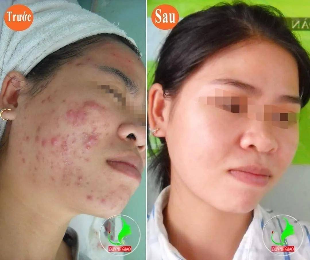 9 Địa chỉ trị mụn chất lượng hàng đầu tại Quận 12, TP. HCM