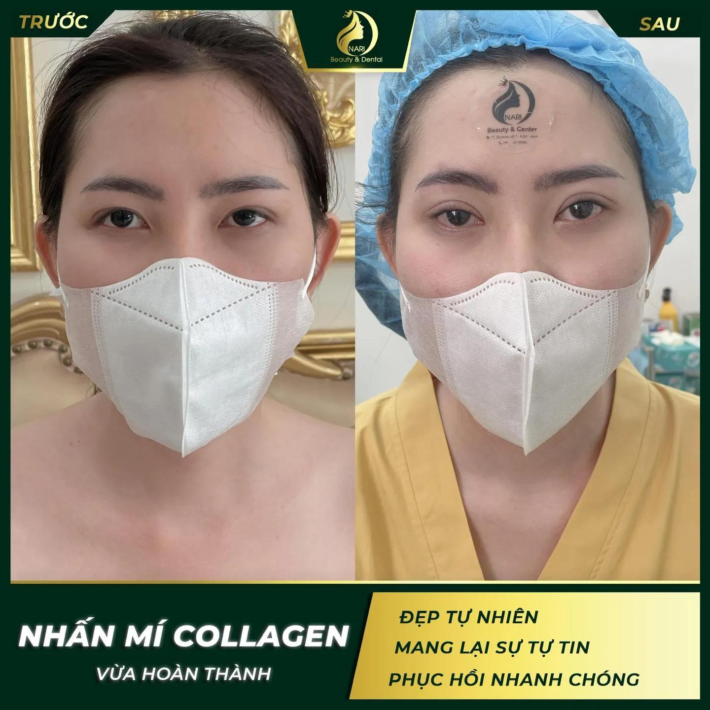 Top 5 địa chỉ cắt mí, nhấn mí đẹp tự nhiên và an toàn bậc nhất tại Cần Thơ