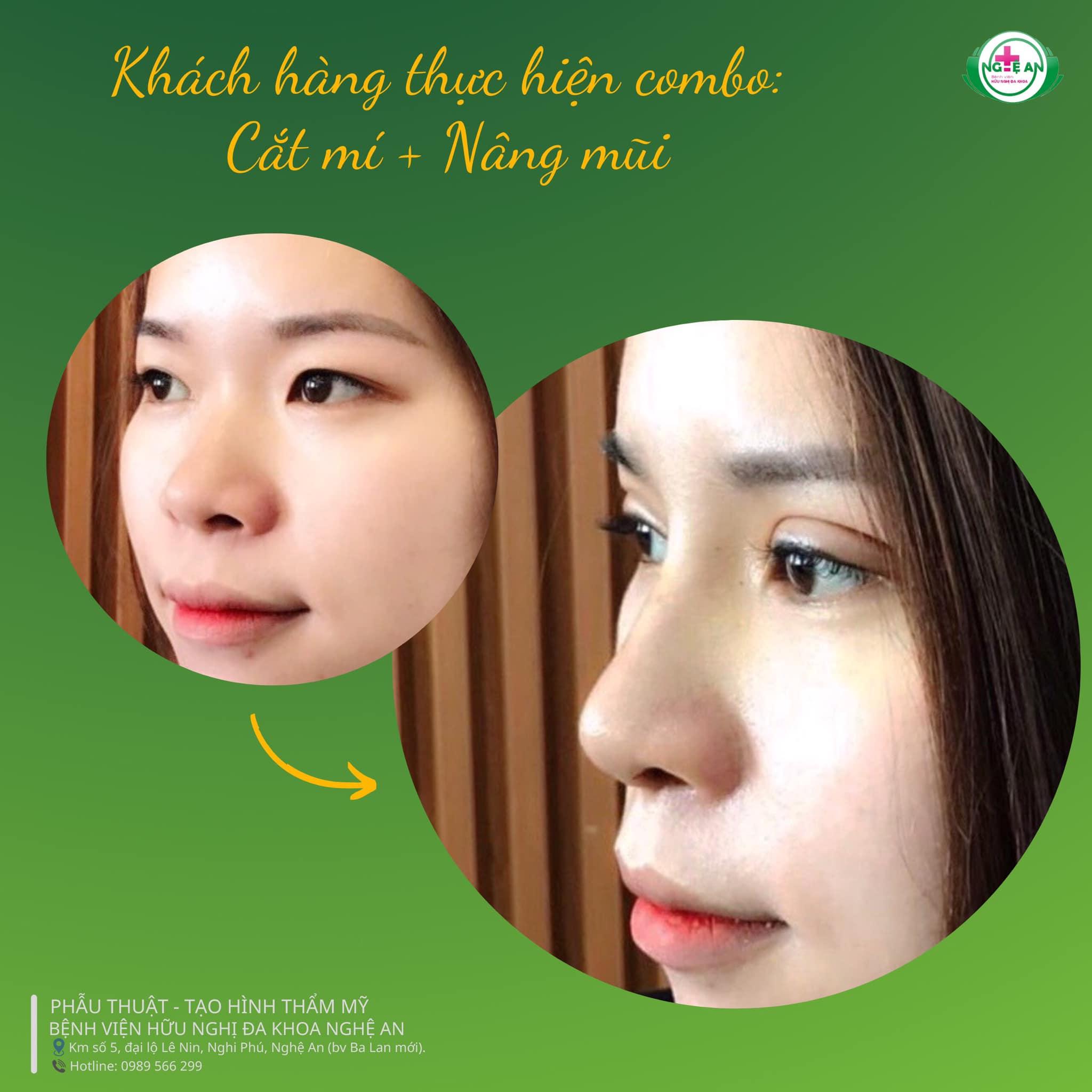 Top 9 địa chỉ nhấn mí, cắt mí chất lượng và đáng tin cậy bậc nhất tại TP. Vinh, Nghệ An