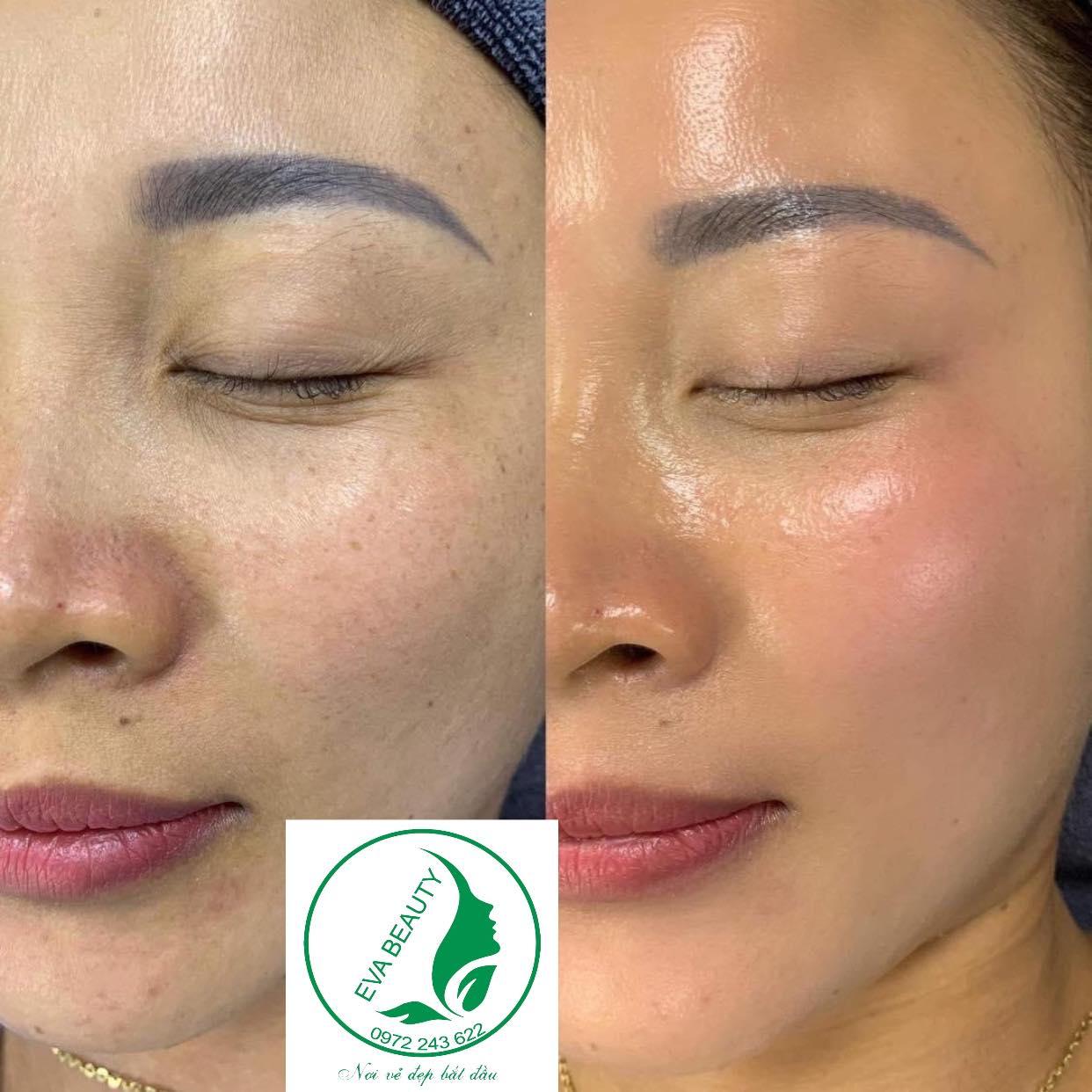 Top 10 địa chỉ trị liệu nám, tàn nhang, đồi mồi hiệu quả tại Thanh Hóa