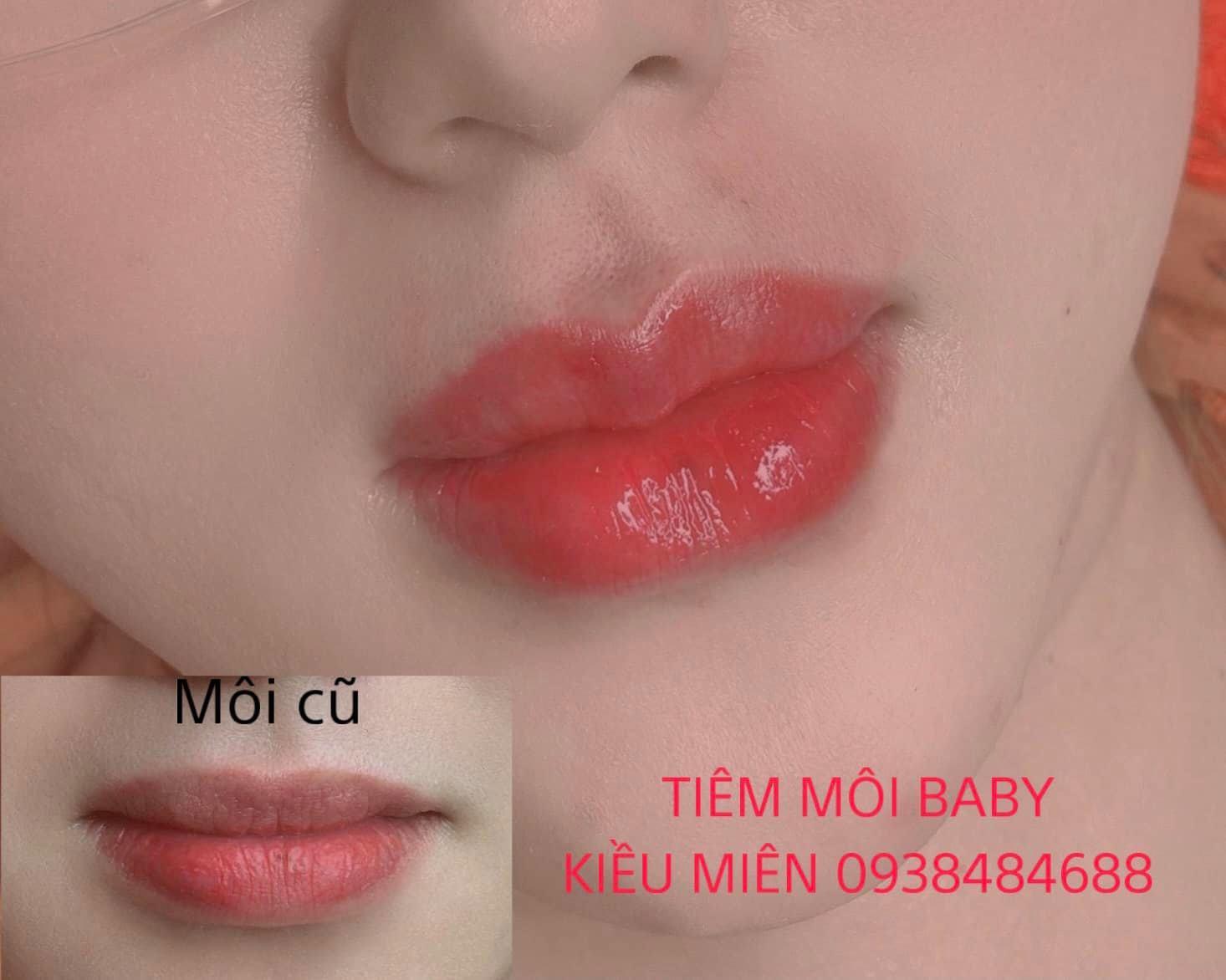 Top 7 địa chỉ uy tín và chất lượng để tiêm filler, botox tại TP. Pleiku, Gia Lai
