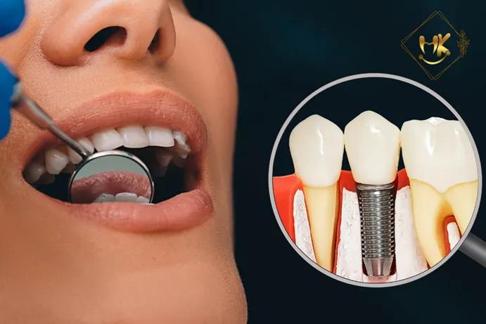 7 Địa chỉ nha khoa trồng răng implant chất lượng nhất tại TP. Quy Nhơn, Bình Định