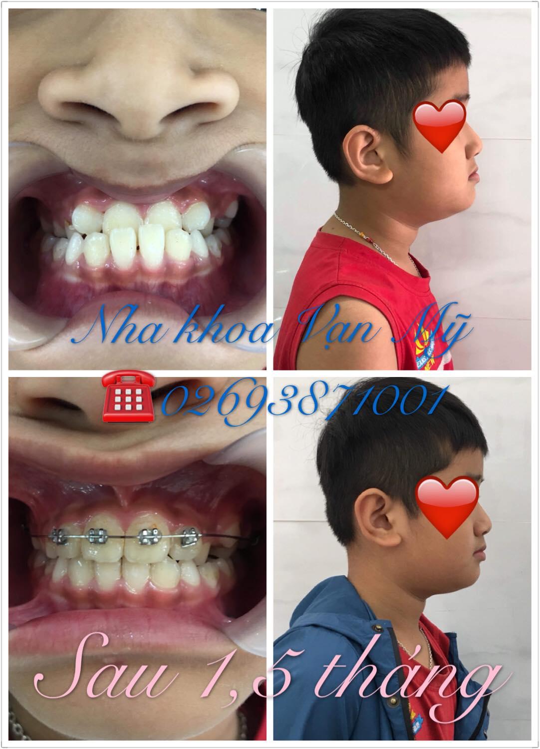 Top 6 địa chỉ niềng răng chất lượng và uy tín hàng đầu tại Gia Lai
