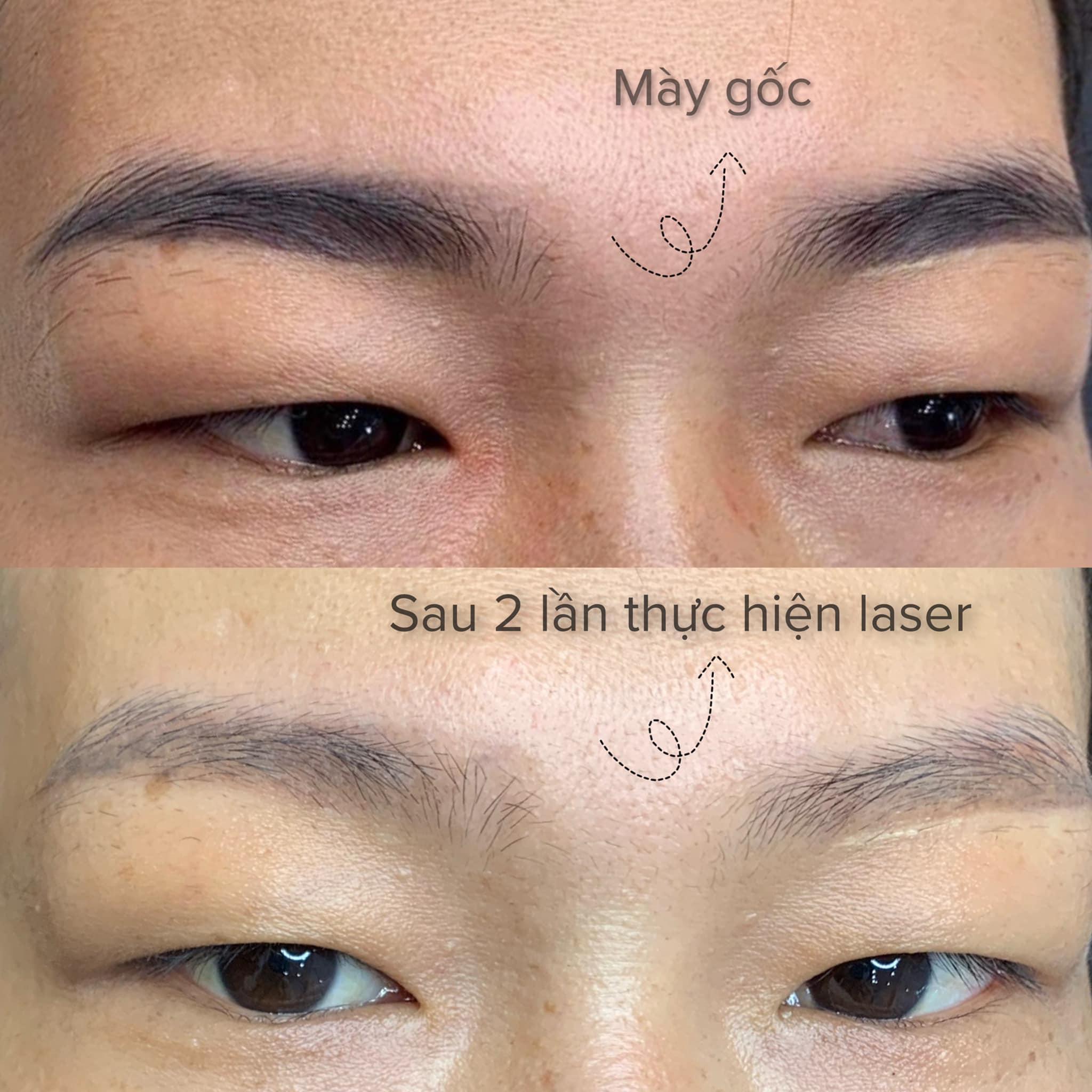 Top 5 Địa chỉ xoá xăm lông mày uy tín tại TP. Quy Nhơn