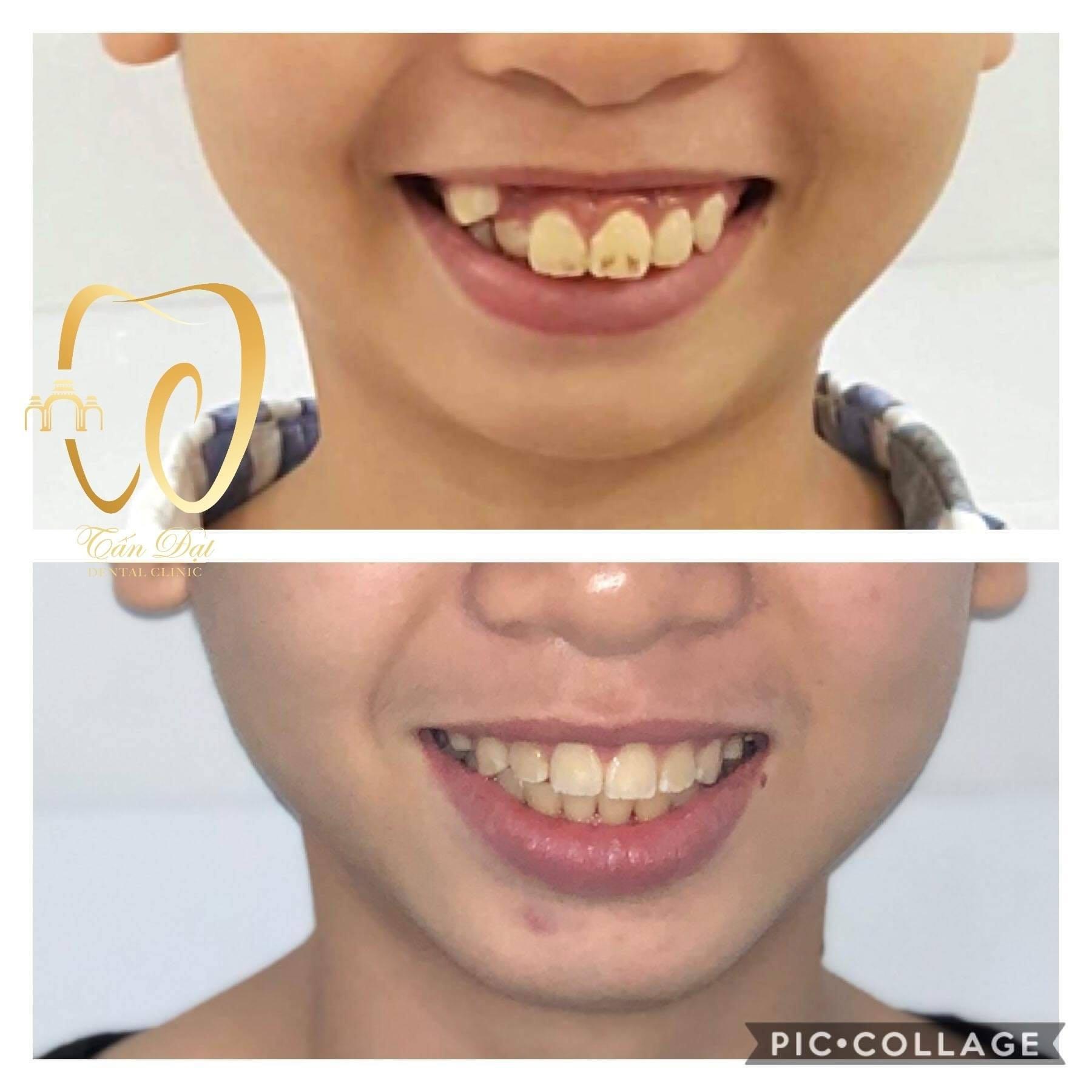 Top 5 địa chỉ niềng răng chất lượng và đáng tin cậy bậc nhất tại thành phố Rạch Giá, Kiên Giang