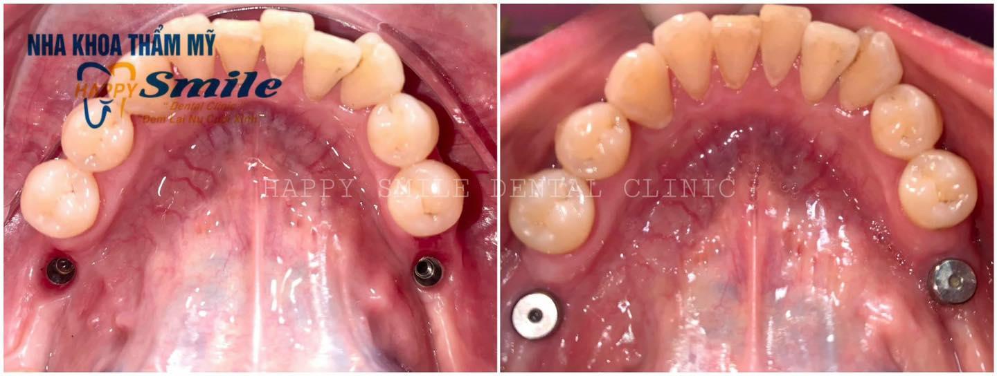8 địa chỉ trồng răng implant chất lượng nhất tại Gia Lai