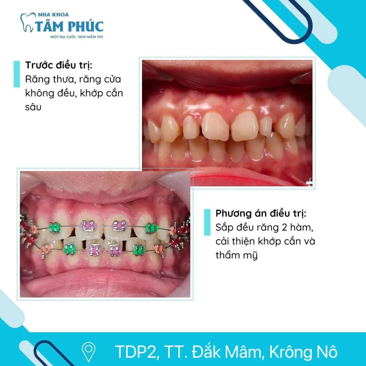 Khám phá 10 địa chỉ niềng răng đáng tin cậy nhất tại Đắk Nông