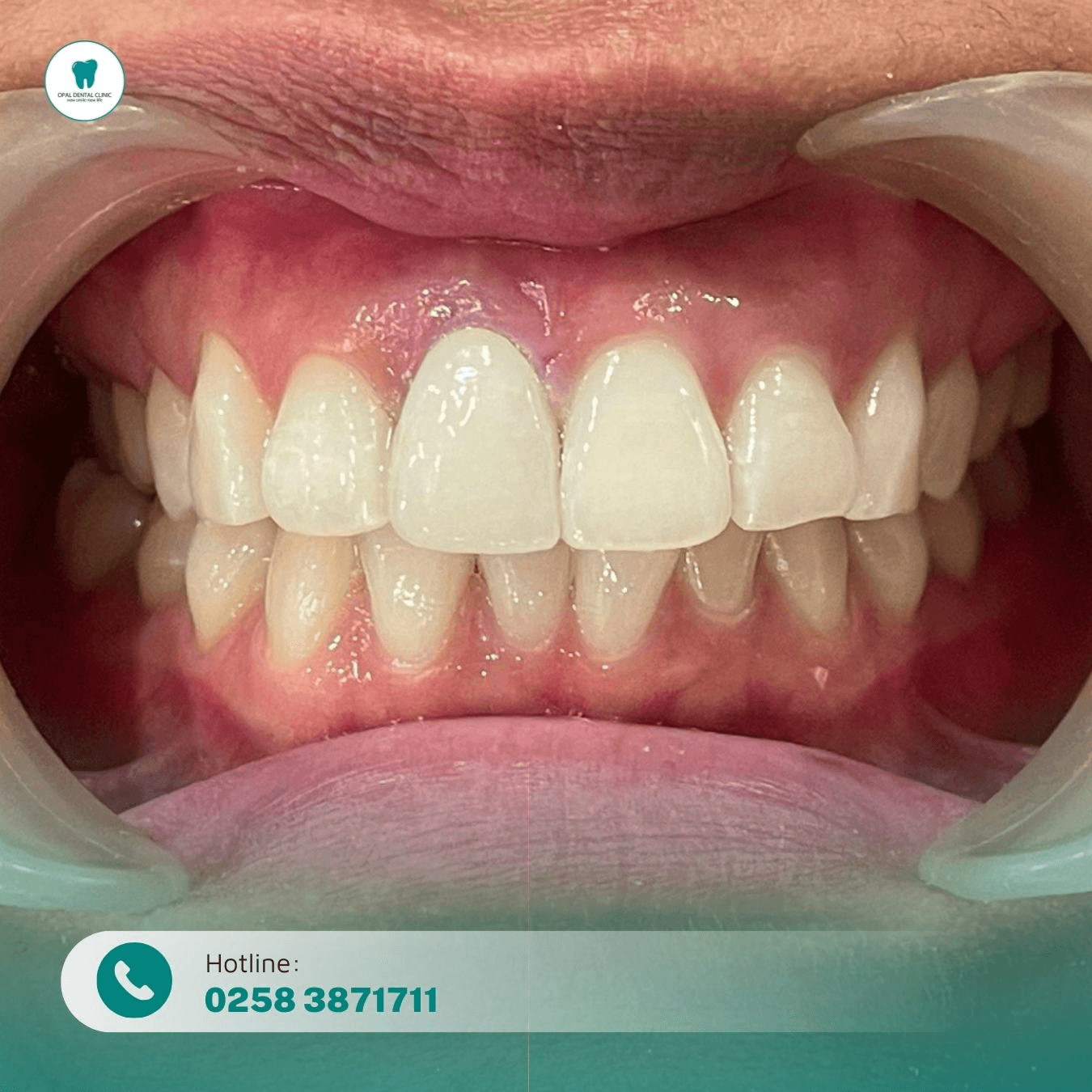 5 địa chỉ nha khoa dán sứ veneer chất lượng hàng đầu tại Khánh Hòa