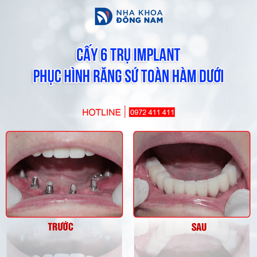 Top 10 địa chỉ nha khoa trồng răng Implant chất lượng nhất dành cho người trung niên tại TP.HCM