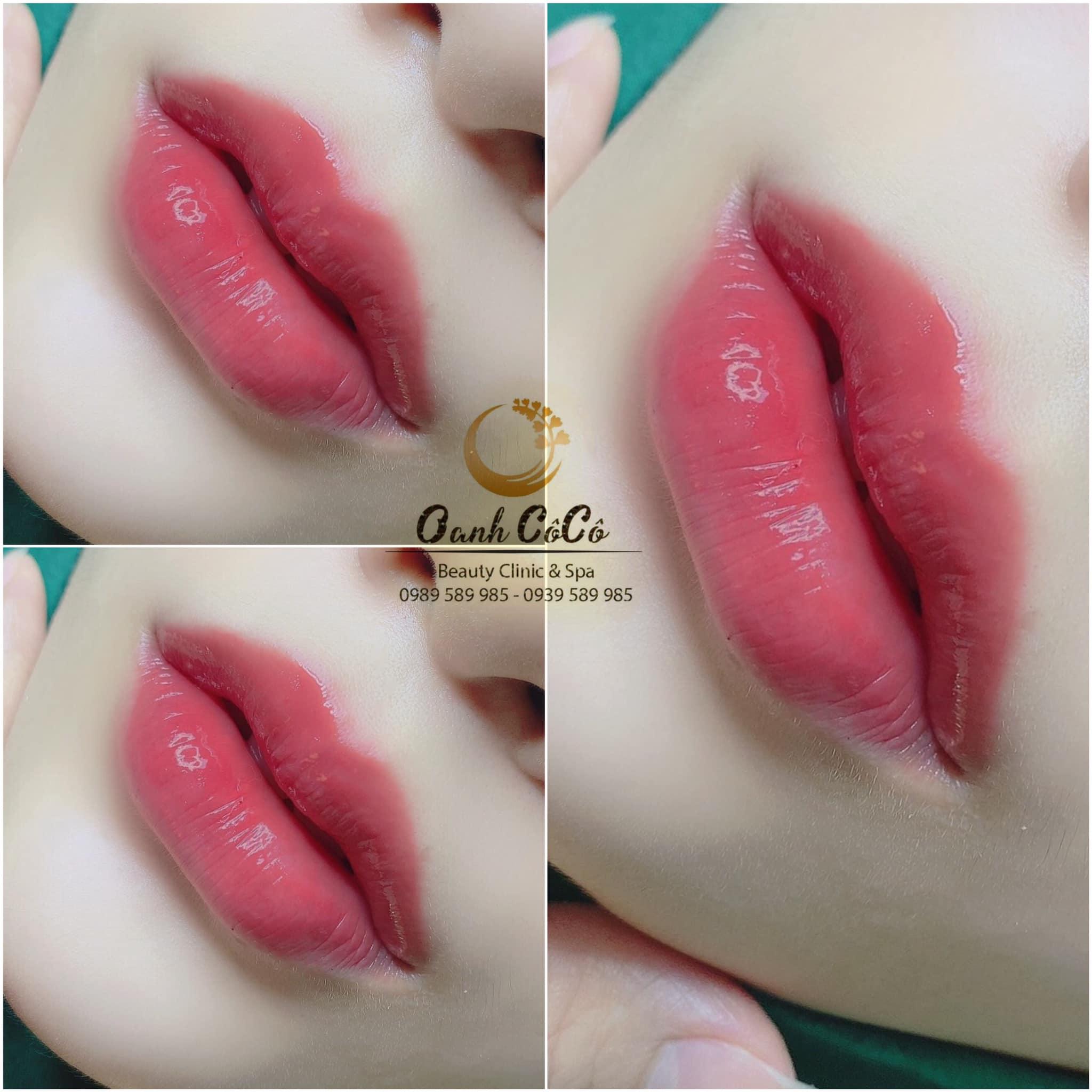 Top 10 địa chỉ tiêm filler và botox uy tín, chất lượng hàng đầu tại TP. HCM