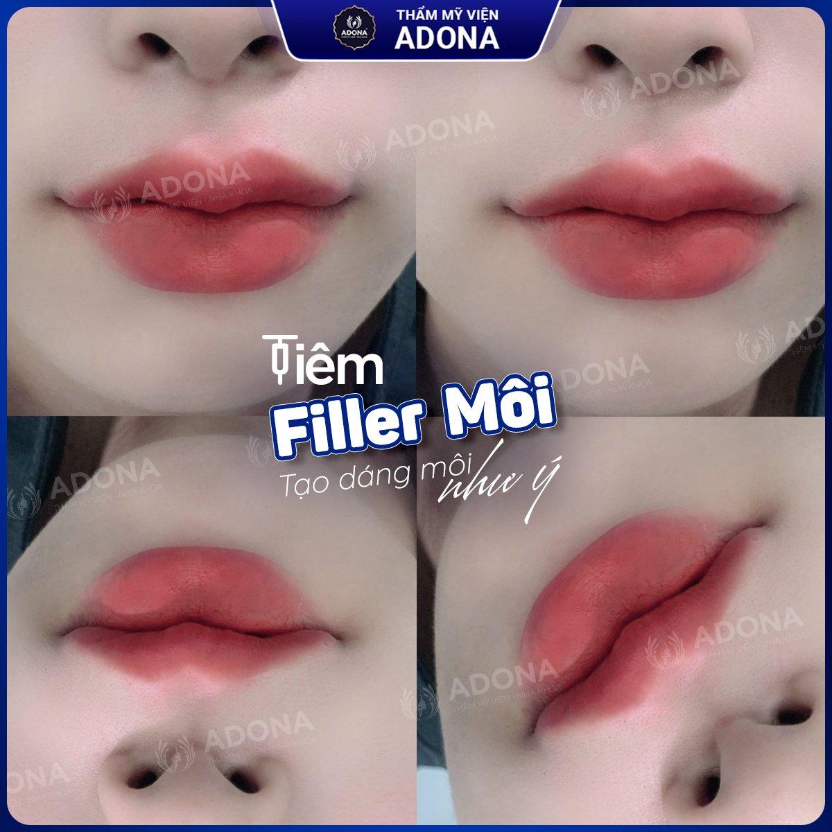 6 địa chỉ tiêm filler - botox chất lượng và uy tín hàng đầu tại quận Gò Vấp, TP.HCM