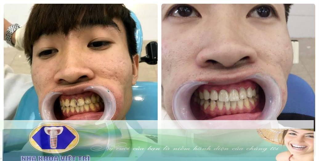 Top 5 địa chỉ nha khoa chất lượng và đáng tin cậy bậc nhất tại Phú Thọ
